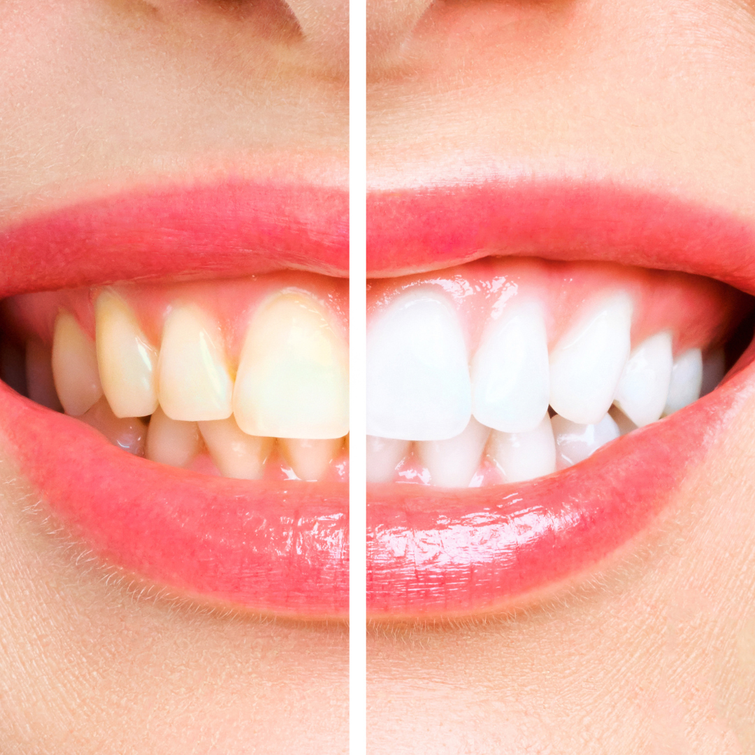 Pourquoi nos dents jaunissentelles ? PAOS